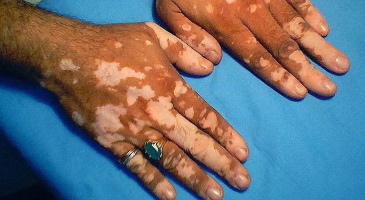 Cura para el vitiligo: medicina natural (VIDEO)