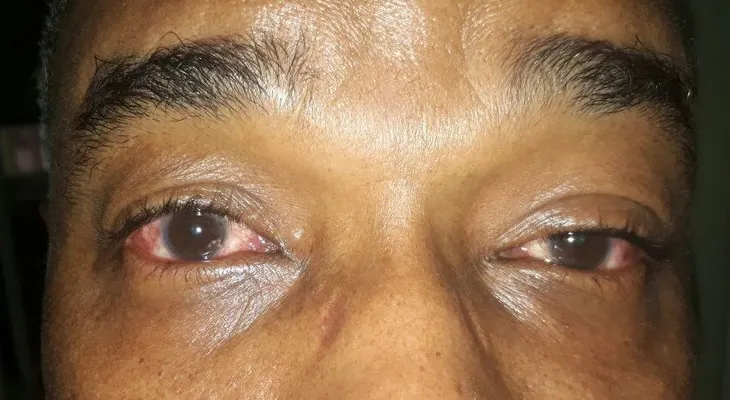 El 8.25% de pacientes consultados ha tenido síntomas de conjuntivitis este año