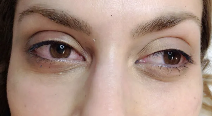 Elimina tus ojeras con este remedio 