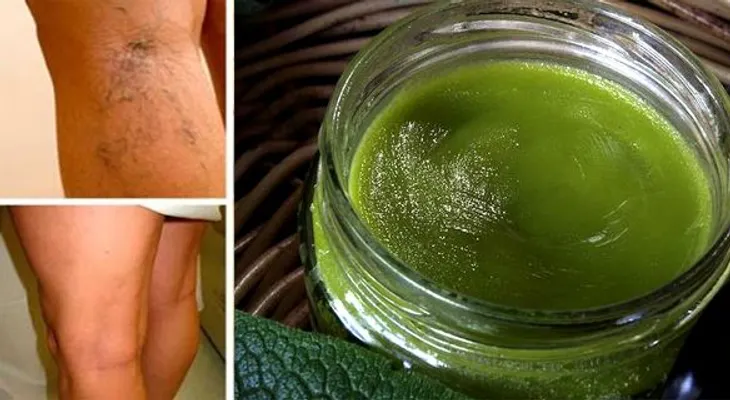 Esta mujer de 42 años curó sus varices con esta antigua receta de la abuelita. Resultados en 1 mes !