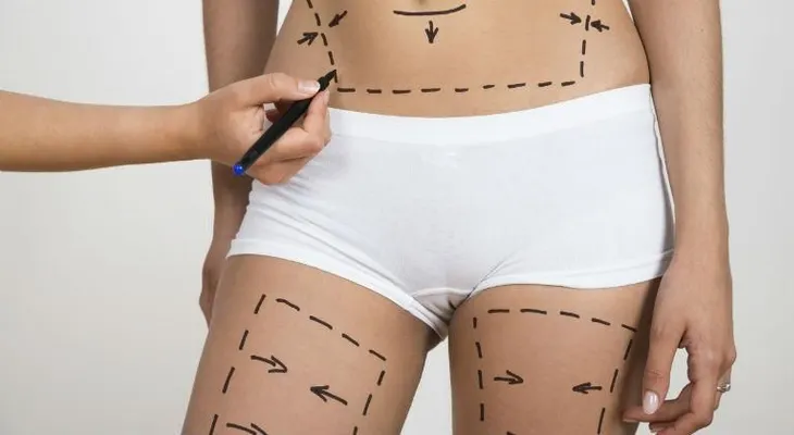 Cinco mitos sobre la liposucción