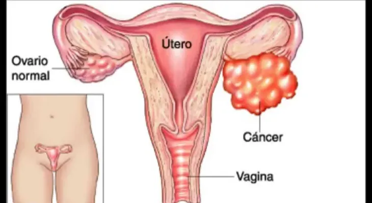 Estos son los dos síntomas más comunes del cáncer de ovarios