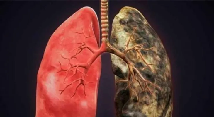 ¿Estás perdiendo capacidad pulmonar?
