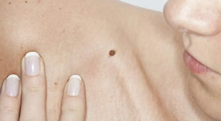La combinación de dos nuevas moléculas frena el cáncer de ovario 