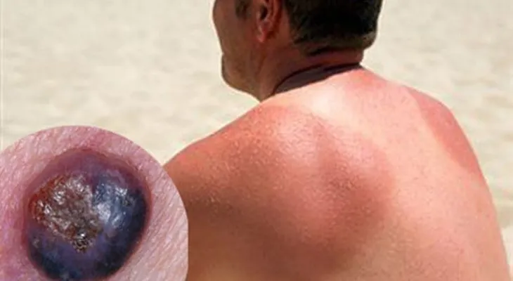 Melanoma, el cáncer de piel más agresivo