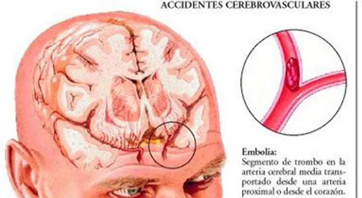 La demencia vascular: síntomas, diagnóstico y tratamiento  (VIDEO)