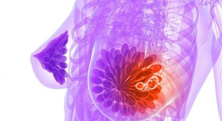 Un avance que ayudará a predecir el pronóstico de los tumores de mama