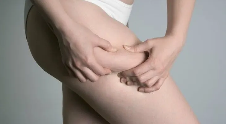 ¿Por qué las mujeres flacas también tienen celulitis?