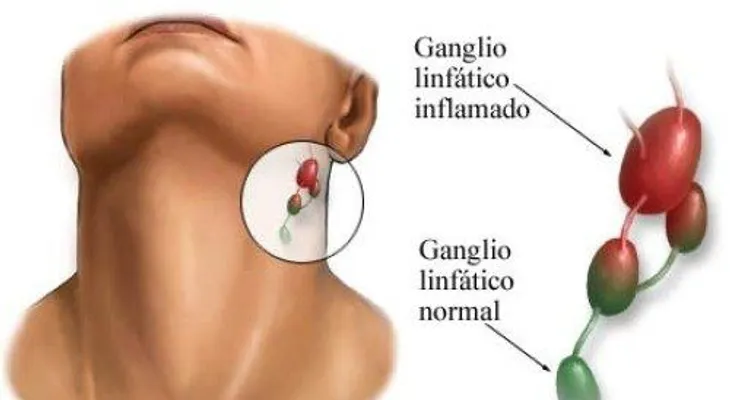 ¿Qué causa la inflamación de los ganglios linfáticos?