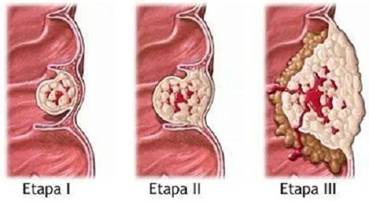 Lo que debes saber sobre el cáncer de colon