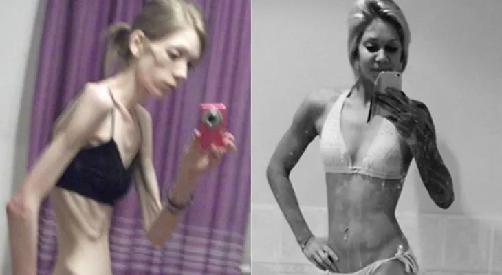 Nicola King, la joven anoréxica que se convirtió en campeona de fisicoculturismo