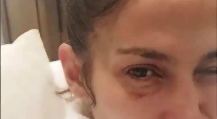 Jennifer López sube foto a Instagram con el ojo "morao"