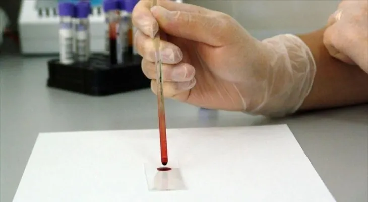 Vienen dos nuevos fármaco contra el cáncer hematológico e inmunoterapi