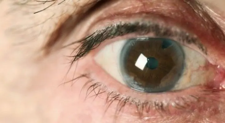 Glaucoma: descubre cuándo ocurre y cómo evitarlo