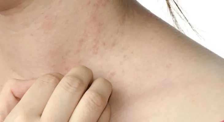 Consejos para tratar la dermatitis de contacto