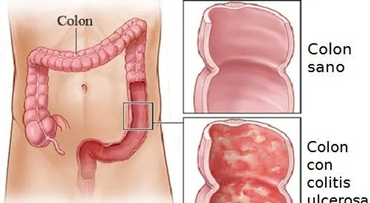 La colitis ulcerosa es una enfermedad crónica del intestino grueso que afecta al colon