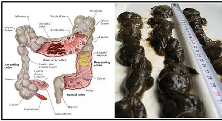 Manzana, jengibre y limón: El más potente limpiador de colon