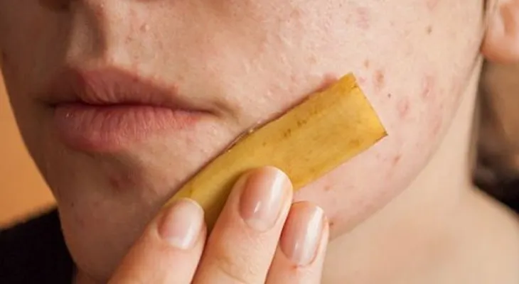 Métodos que FUNCIONAN para eliminar lunares, fibromas, espinillas, verrugas y manchas de la piel
