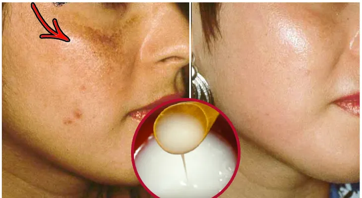 3 Remedios caseros para eliminar las manchas en el rostro