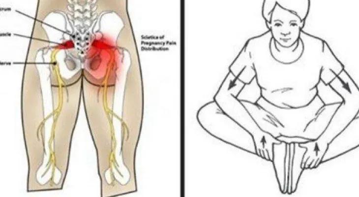 Como quitarse el dolor ciático de inmediato