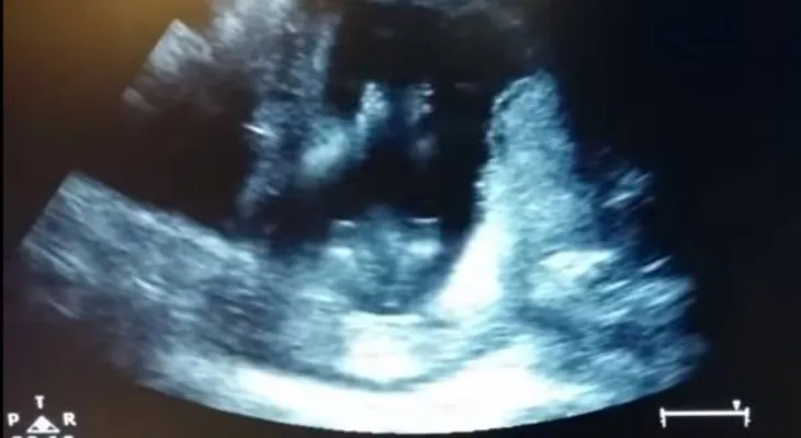 Feto de 14 semanas aplaude durante un sonograma