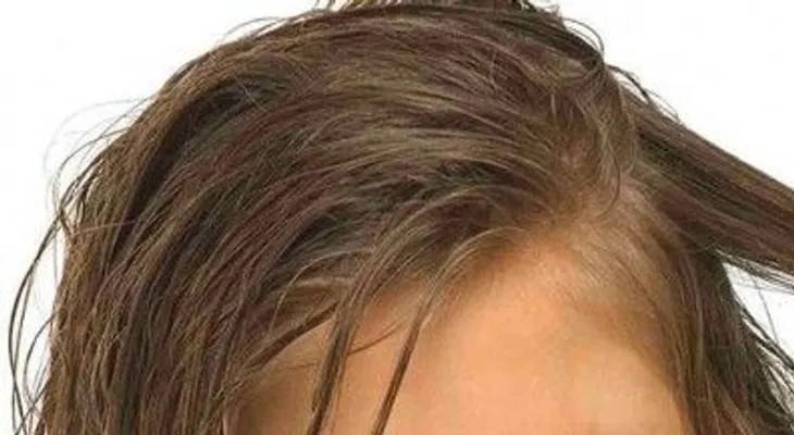 Remedios para los piojos: Mayonesa y vinagre, enjuague bucal y un champú natural