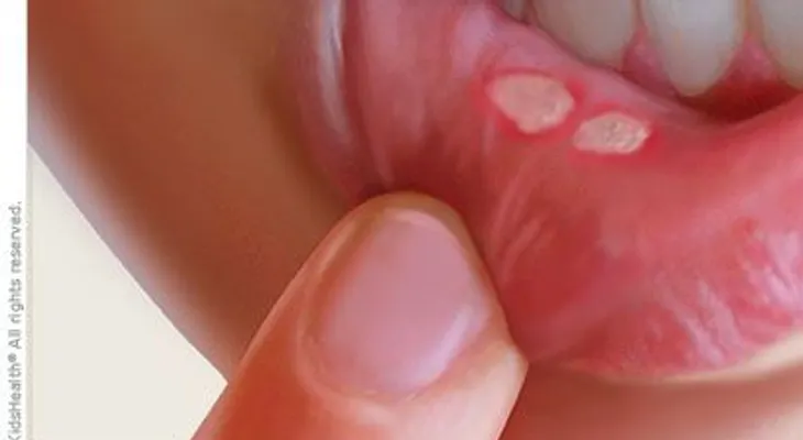 Elimina las aftas (llagas) de tu boca en 2 minutos 