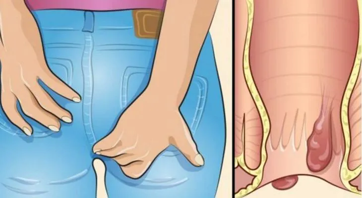 Picazón anal, remedios para que te cure