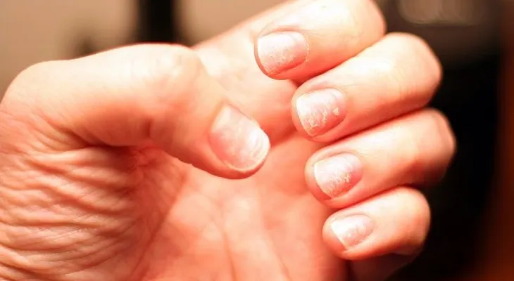 Cómo tener uñas más fuertes con el uso del ajo