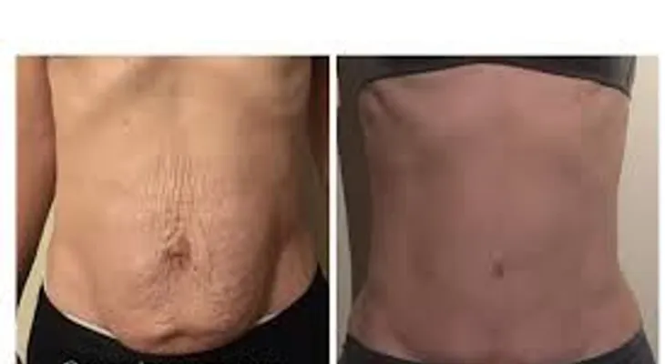 Asegura que 9 de cada 10 mujeres terminan con el hombre que estuvo con ella antes de la lipo