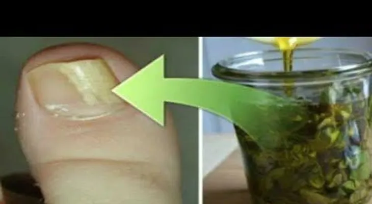 Con unas gotitas de orégano al día, y los hongos de tus uñas se secarán por completos