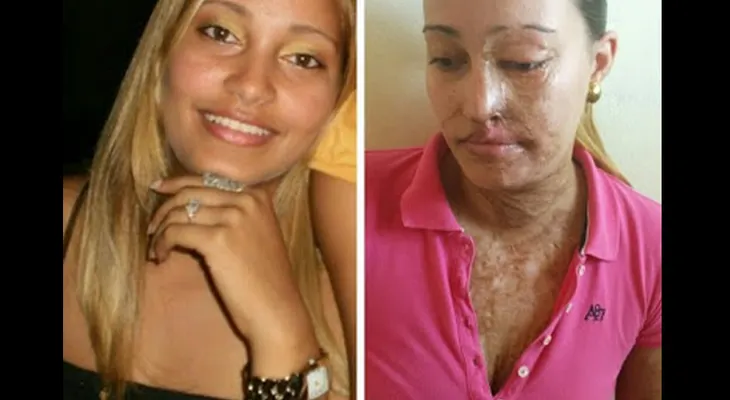 Pide ayuda Estefany Díaz Pena, a quien delincuentes le quitaron la belleza con Acido del Diablo