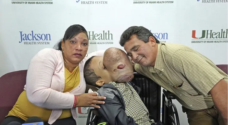 IMAGENES SENSIBLES: Extirparán en Miami un tumor de 4,5 kilos del rostro de un niño cubano
