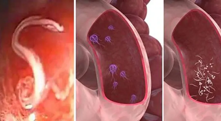 Si sientes estos síntomas significa que tienes los intestinos llenos de parásitos. Soluciones para eliminarlos