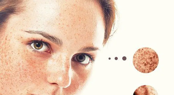 Si con esta receta no eliminas las manchas de tu piel y rostro ninguna otra cosa lo hará!