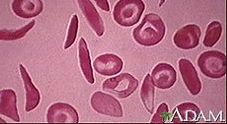 Anemia falciforme: tratamientos y terapias