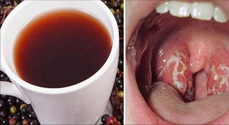 Como quitar la infección de garganta en 4 horas..... Tu también puede hacerlo!!..