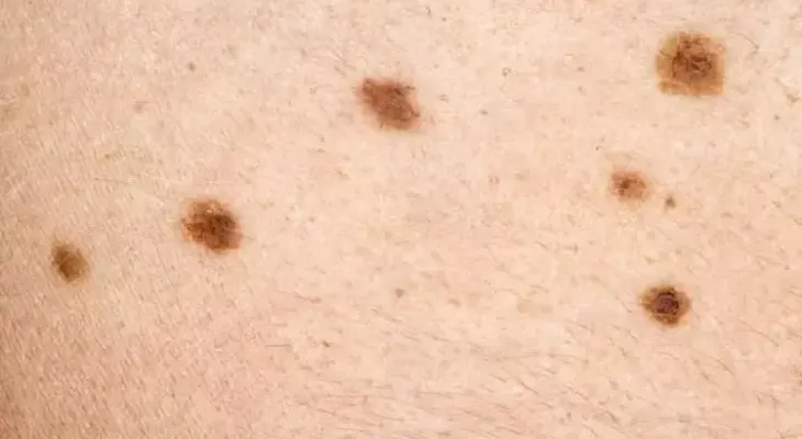 El cáncer de piel sería detectado con dispositivo de la Inteligencia Artificial 
