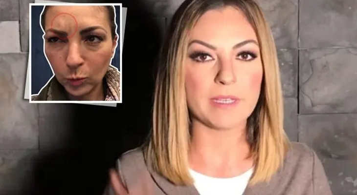Mariana Ochoa comparte su experiencia con el uso de botox