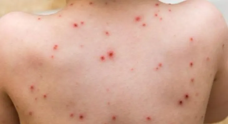 El Sistema Epidemiológico de México detecta cuatro nuevos casos de sarampión; emiten alerta 