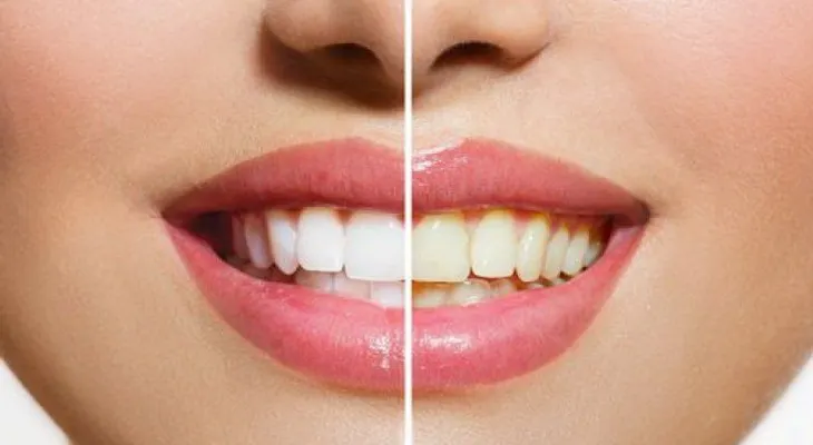 6 motivos por los que tus dientes lucen amarillos