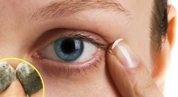 Cómo eliminar las ojeras bajo los ojos con remedios caseros