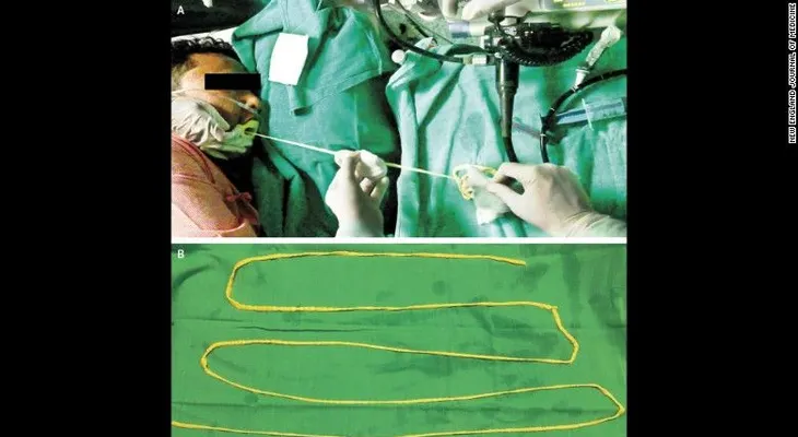 Doctores impactados: Una solitaria de 1,8 metros de largo salió por la boca de este hombre