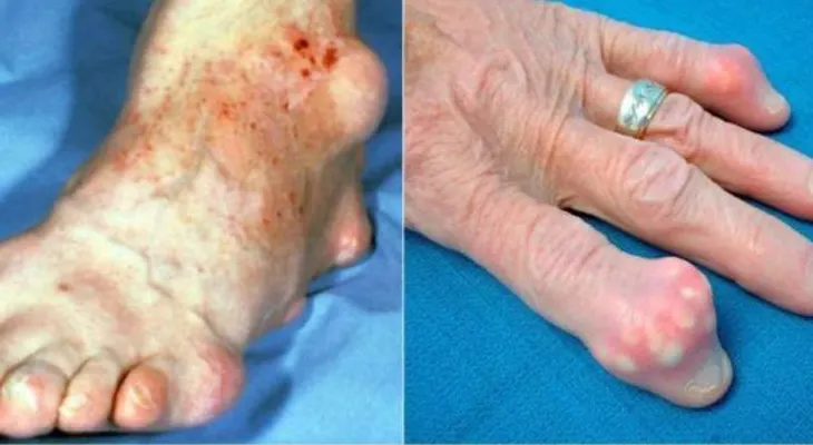 Revelan el secreto para la cura del reumatismo, artritis y articulaciones