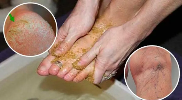 En sólo minutos desaparecerán las várices, los callos y pies agrietados con este remedio casero?