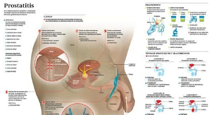 Remedios para prostatitis bacteriana aguda y crónica