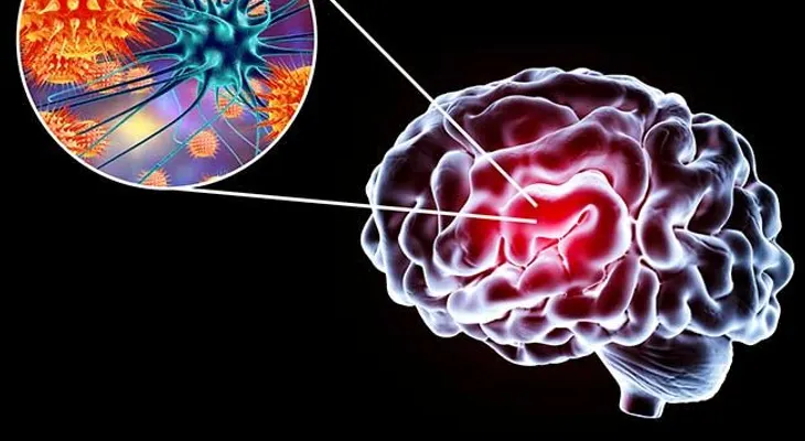 Encefalitis viral aguda; diagnóstico y tratamiento