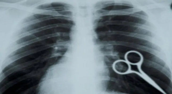 5 objetos horribles encontrados en el cuerpo humano