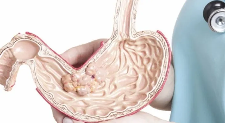 Seis síntomas del cáncer estomacal que no tienen nada que ver con el dolor