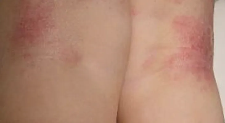 Las sábanas y fundas de almohadas producen bacterias, sudor y ácaros, que te irritan y pican la piel 